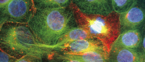 Menancing mitosis: prostate cancer cells undergoing rapid division. Nancy Kedersha/Photo Researchers, Inc. 